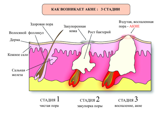 Механизм возникновения акне - Клиника Аврора в Краснодаре | Официальный ...